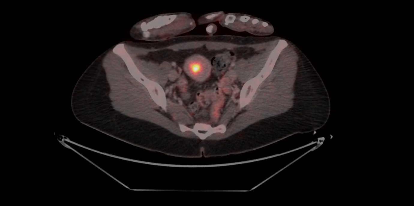 NEWS_Endometrium_Immuntherapie.jpg