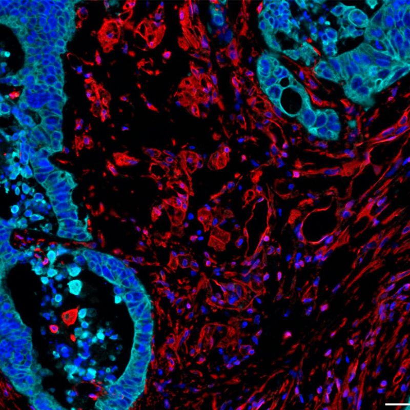 Die Immunfluoreszenz-Aufnahme zeigt eine Anhäufung fibrotischer, sauerstoffarmer Regionen (rot) am Tumorrand. ©Manuel Trebo