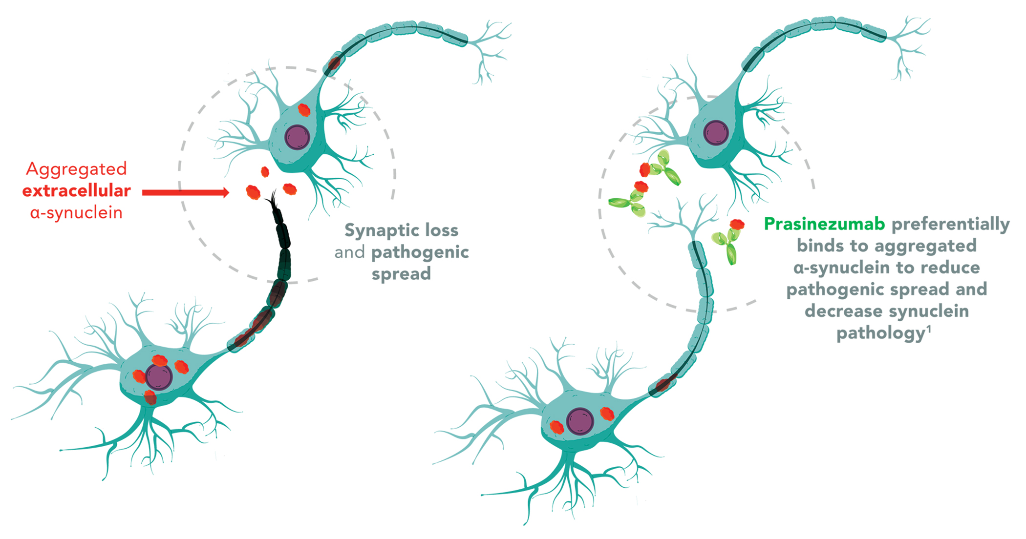 Lancet Publikation bereitet Weg für erste „Parkinson-Impfung“