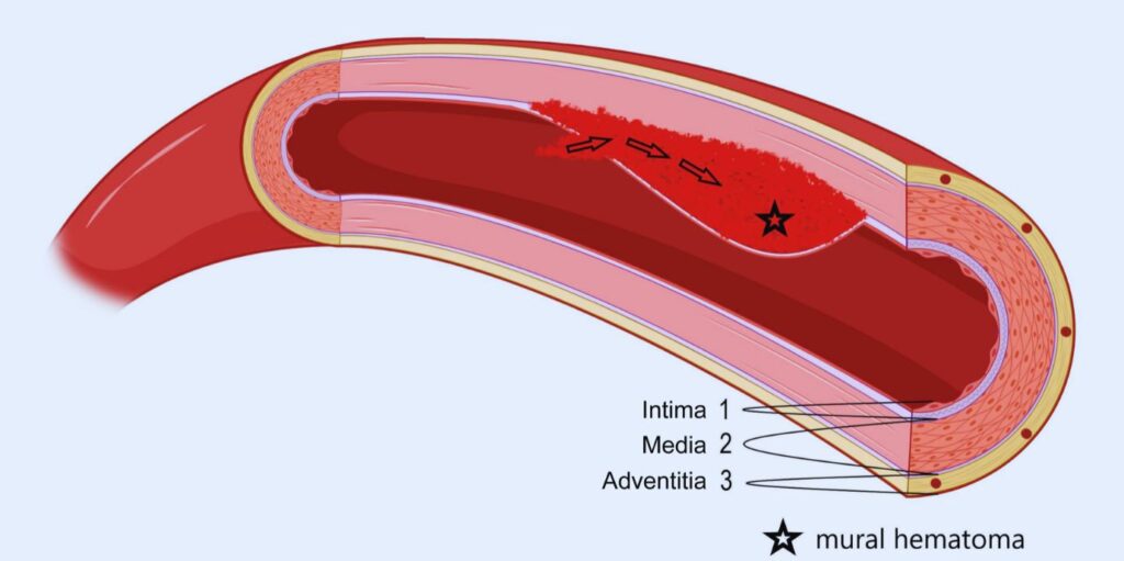 Die Grafik zeigt ein Hämatom in der Gefäßwand der Schlagader, das mit einem erhöhten Schlaganfallrisiko einhergeht. 

Grafik: Dejakum B, Kiechl S, Knoflach M and Mayer-Suess L (2024) A narrative review on cervical artery dissection-related cranial nerve palsies. Front. Neurol. 15:1364218. doi: 10.3389/fneur.2024.1364218 